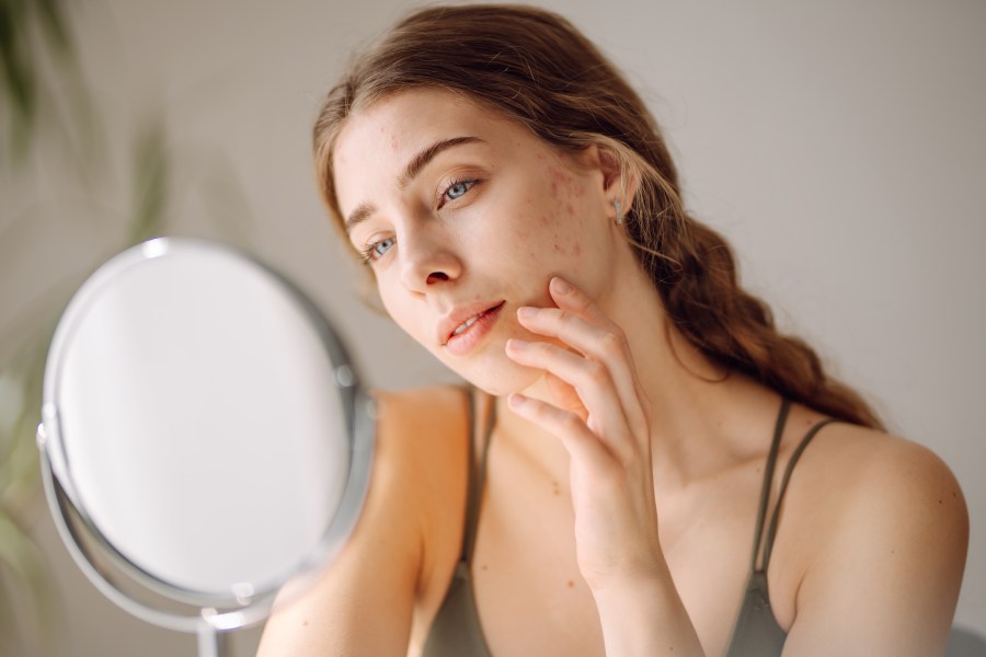 Learn how to how to minimize rosacea flare-ups naturally