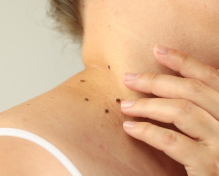 Dr Cunliffe shares the moles you should never ignore