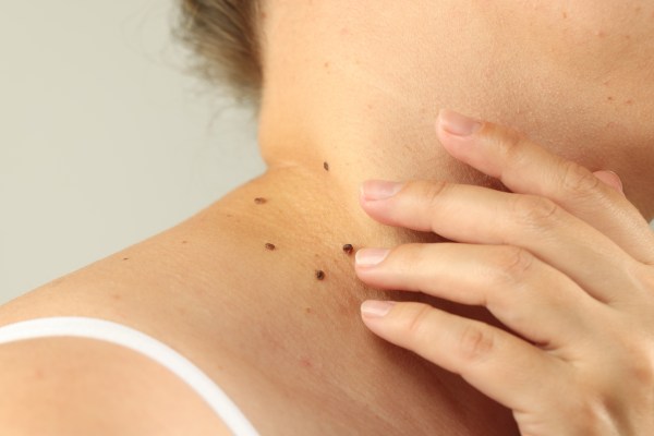 Dr Cunliffe shares the moles you should never ignore