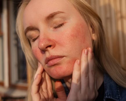 Learn how to how to minimize rosacea flare-ups naturally