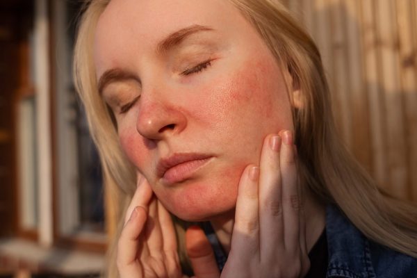Learn how to how to minimize rosacea flare-ups naturally