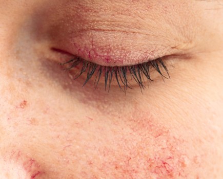 Can rosacea affect your eyes? According to celebrity facialist Nathalie Eleni, it can