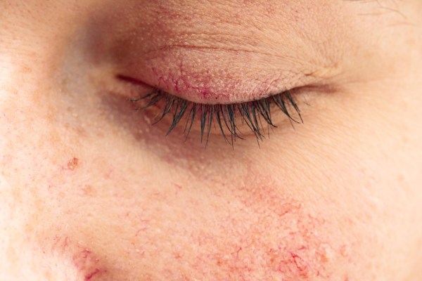 Can rosacea affect your eyes? According to celebrity facialist Nathalie Eleni, it can