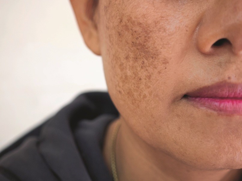 Problem skincare and health concept. Wrinkles, melasma, Dark spots, freckles, dry skin on face middle age woman .
