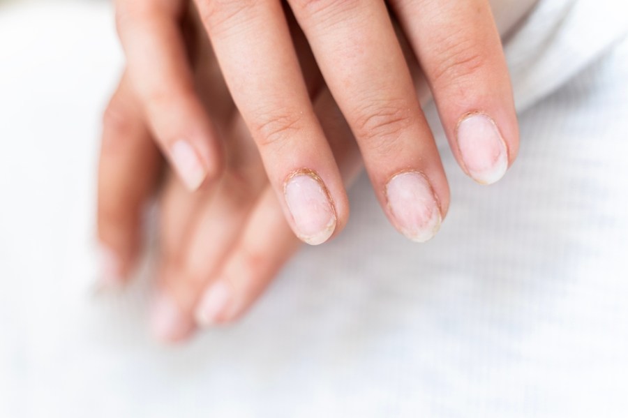 Discover what could be causing dry, brittle nails and how to fix the problem