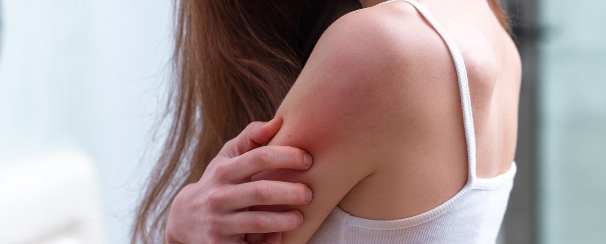 cnm eczema