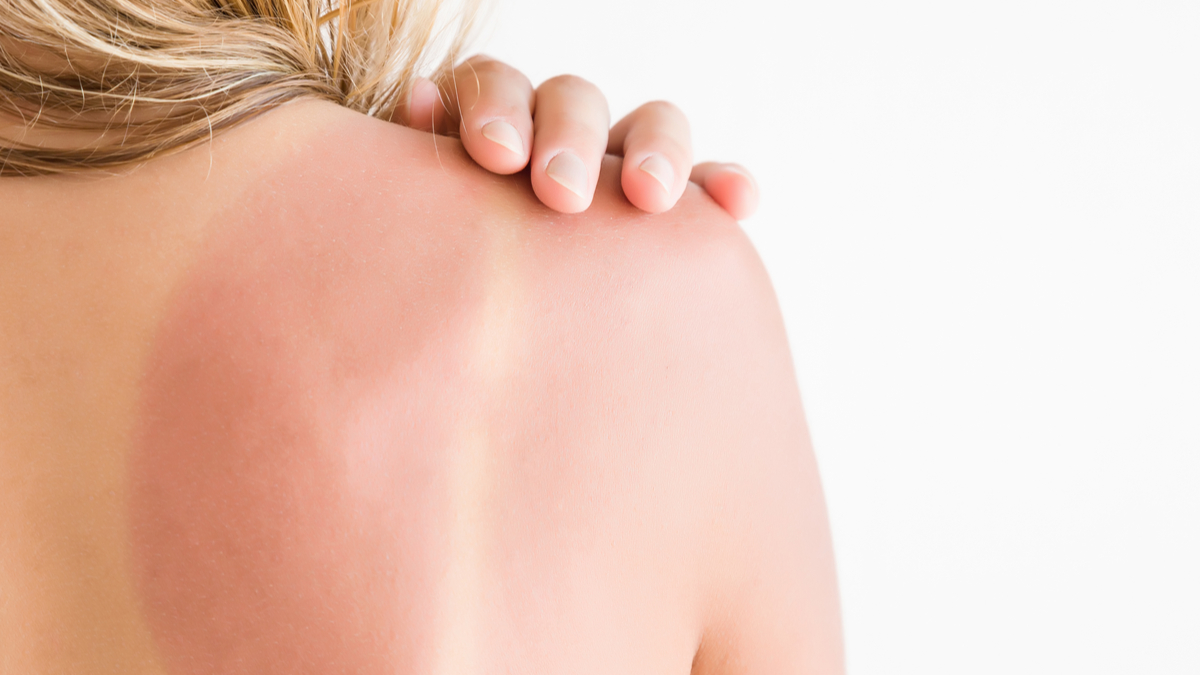 skin cancer advice from specialist SPF sun burn
