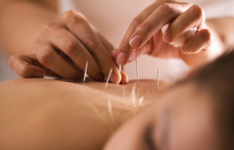 acupuncture cnm